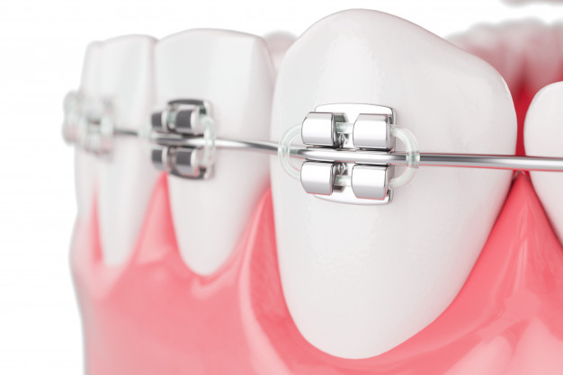 https://www.moacirpires.com.br/wp-content/uploads/2020/09/close-up-beauty-health-teeth-with-brace-selective-focus-3d-render_40193-409.jpg